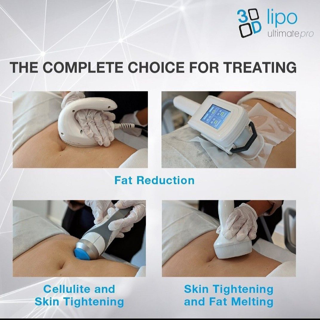 lipo-cavitation treatment result